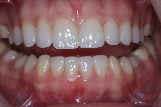 smile after veneers