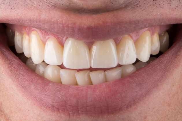 after dental crowns