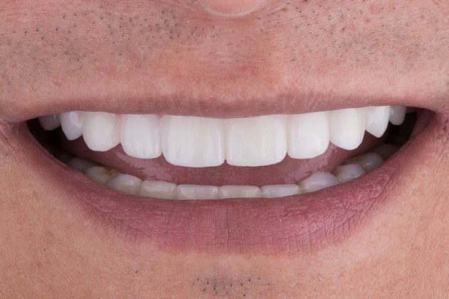 after restorative dentistry