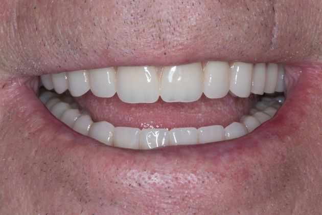 After dentures
